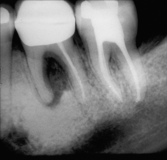 7 Radiographic Expression of Endodontic Disease | Pocket Dentistry