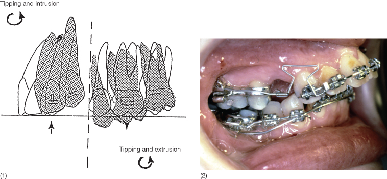 Laceback demo ant. anchorage control prevention of canine mesial tipping  clinical tips- orthodontics 