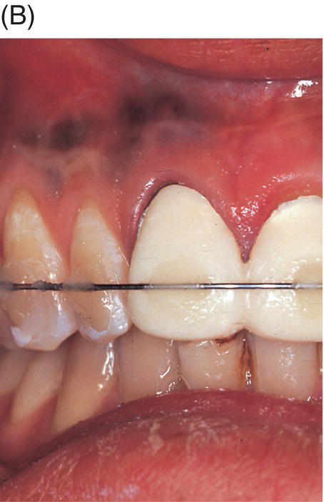 Dark pigmentation in the oral cavity - Clinical Advisor