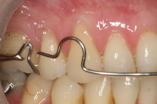 9 Problems With Retainers And Trouble Shooting Pocket Dentistry