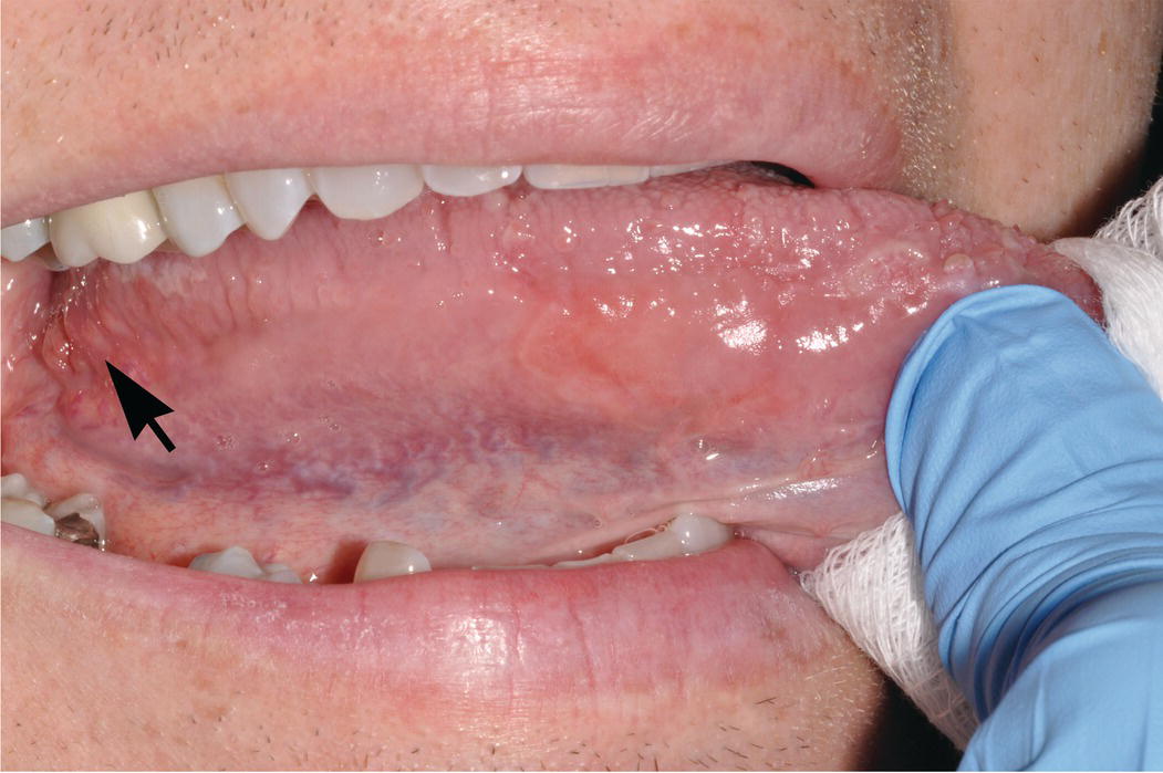 ventral buccal mucosa tongue