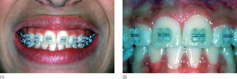 Ceramic brackets bonded to ceramic restorations in-vivo.