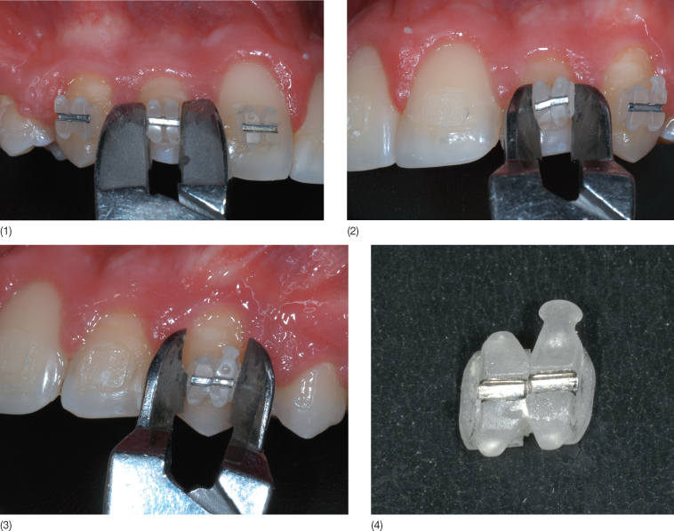 9 Bonding Problems Related to Adult Rehabilitated Dentitions