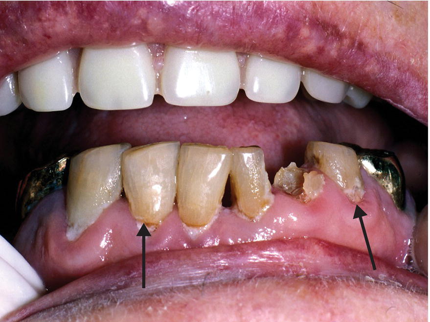 Viscosity Of Saliva And Dental Caries at Caroline Fay blog