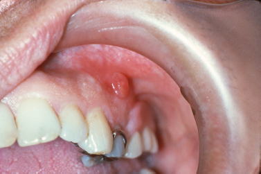 granulation tissue mouth