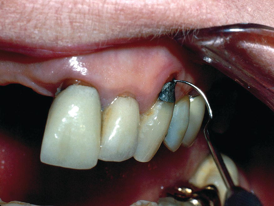 10: Root Caries | Pocket Dentistry