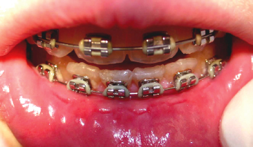 10 Material Related Adverse Reactions In Orthodontics Pocket Dentistry