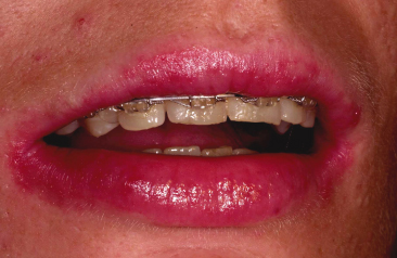 10 Material Related Adverse Reactions In Orthodontics Pocket Dentistry