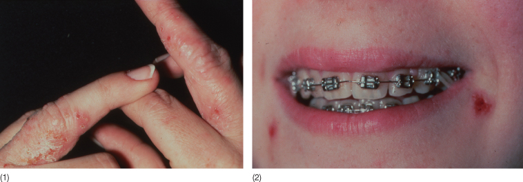 10 Material Related Adverse Reactions In Orthodontics Pocket Dentistry