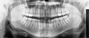 10 Radiopacities  Pocket Dentistry