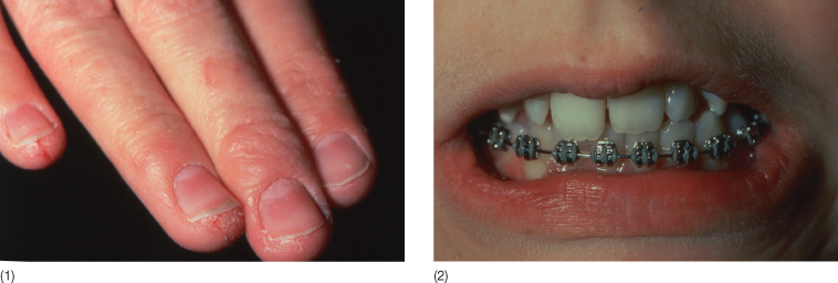 10 Material Related Adverse Reactions In Orthodontics Pocket Dentistry