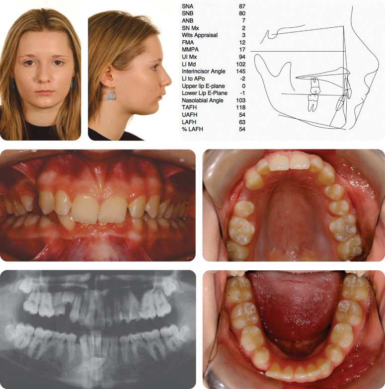 Orthognathic Surgery Pocket Dentistry