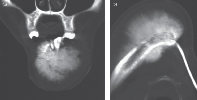 10 Radiopacities  Pocket Dentistry