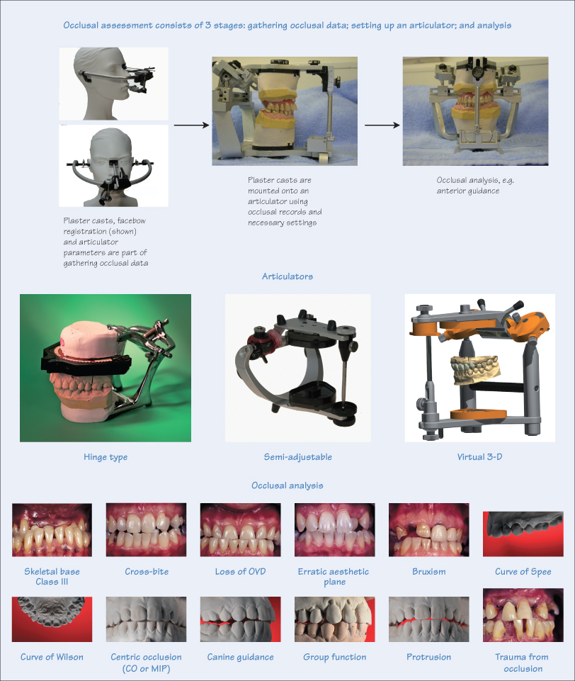 10 Occlusal analysis | Pocket Dentistry