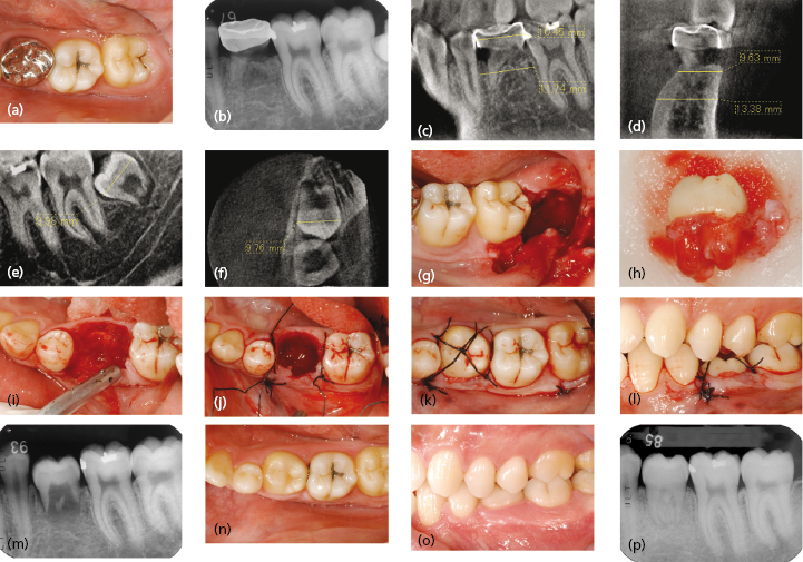 11 Autotransplantation Of Teeth Pocket Dentistry