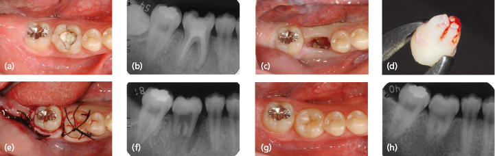 11 Autotransplantation Of Teeth Pocket Dentistry