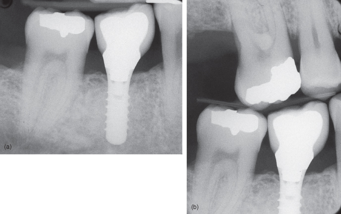 12 Radiographic Imaging In Implant Dentistry Pocket Dentistry