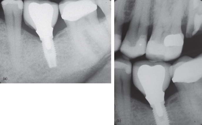 dental implant xray