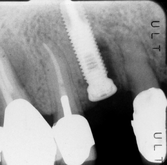 Dental Implant Xray