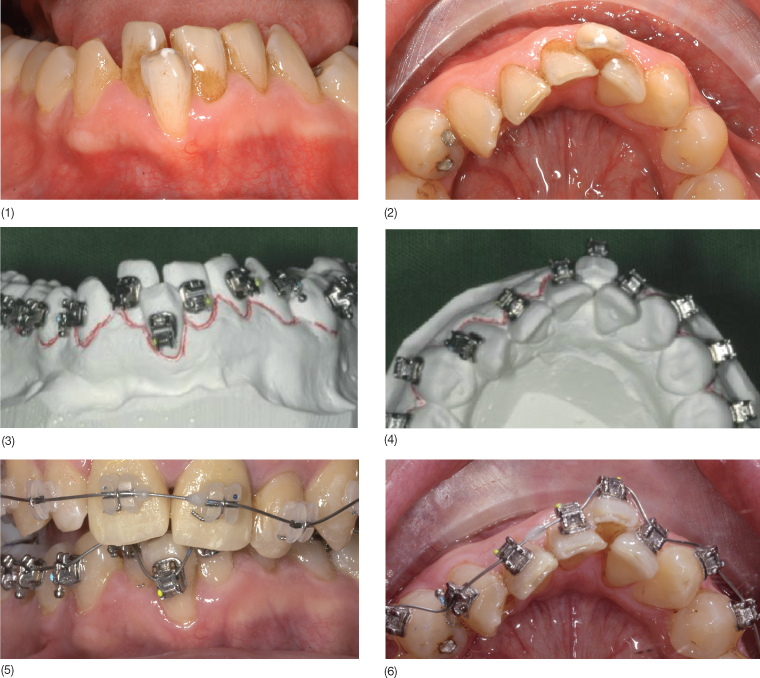 Dental Tip Out Bins, GP, Ortho, Perio