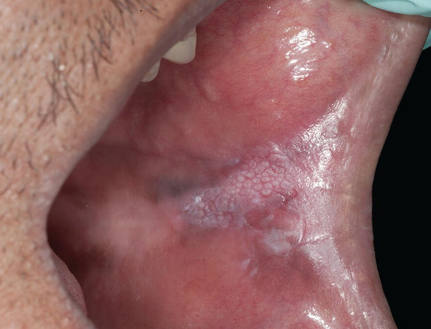 mucosal burn