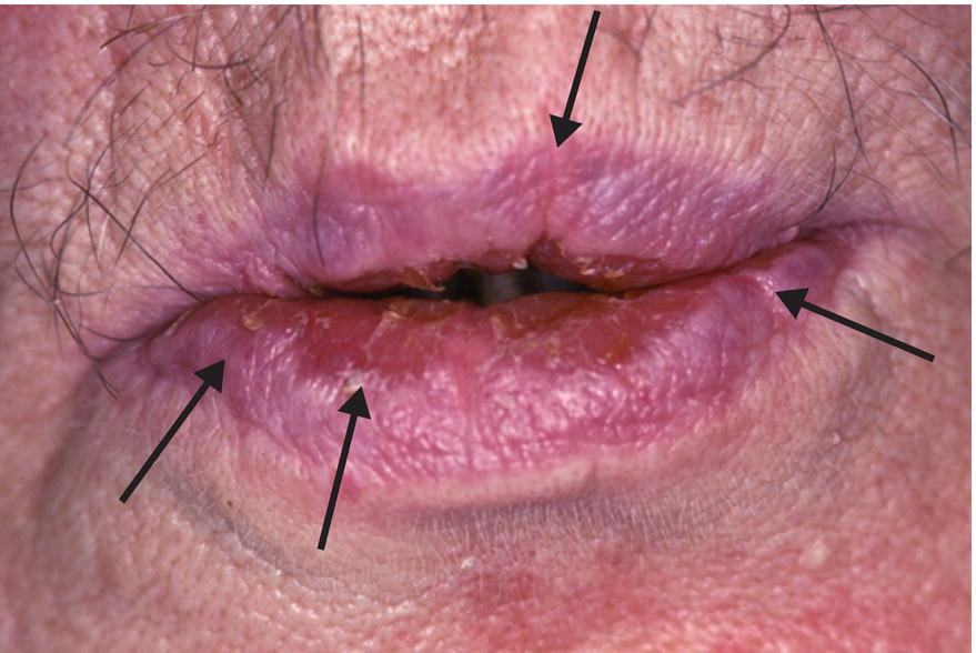 Xerostomia Mouth