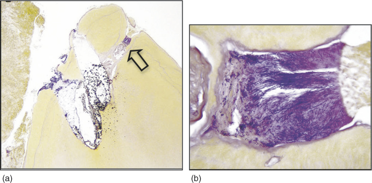 Root Canal Disinfection Using Highly Effective Aggregation-Induced