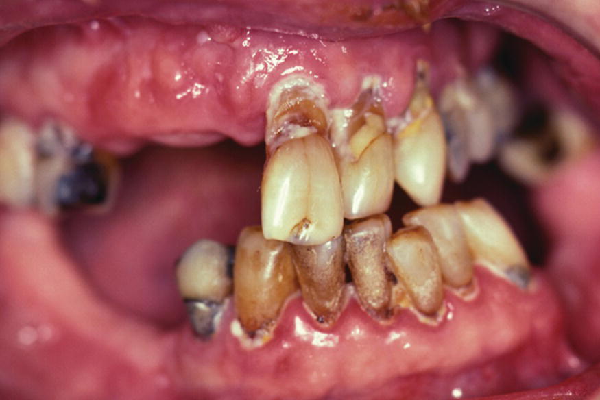 xerostomía caries y