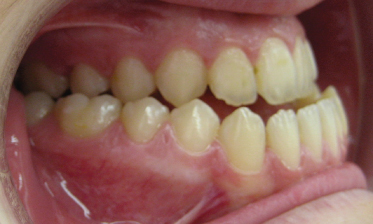 class 3 malocclusion