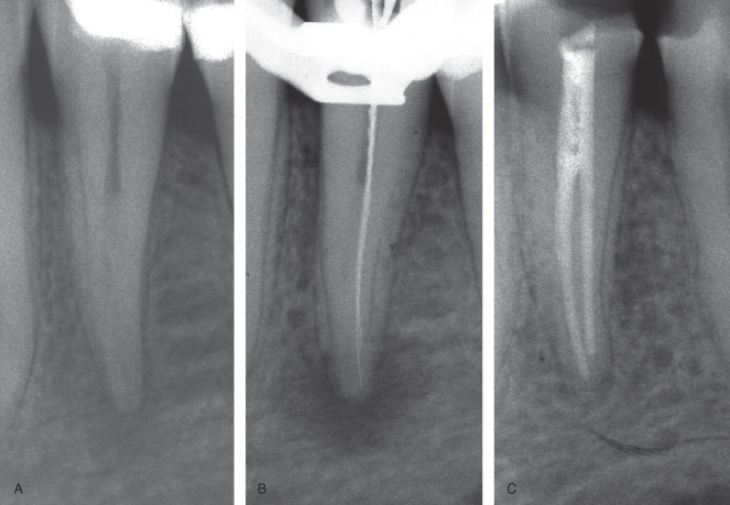 acute apical periodontitis