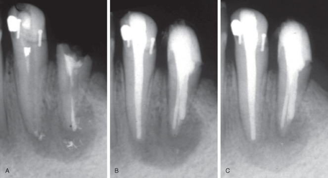 16 Healing Of Chronic Apical Periodontitis Pocket Dentistry
