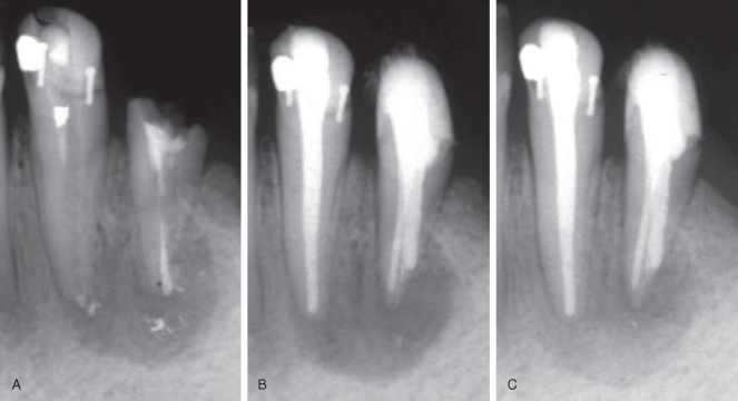 acute apical periodontitis