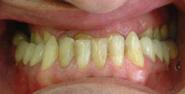 class 3 malocclusion