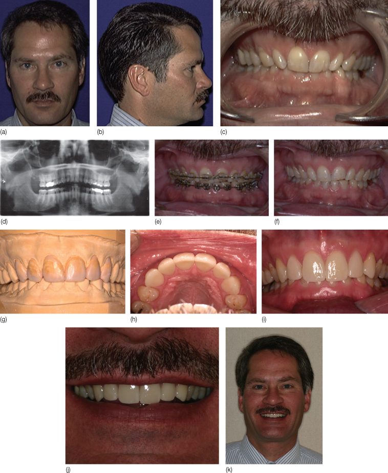 Pre-orthodontic treatments  Dental procedures before aligners 🦷