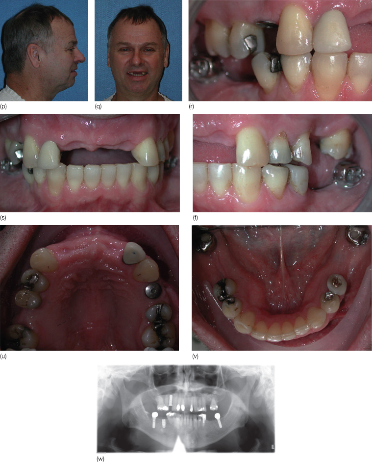 17 Pre-Prosthetic Orthodontic Tooth Movement: Interdisciplinary Concepts  for Optimizing Prosthodontic Care