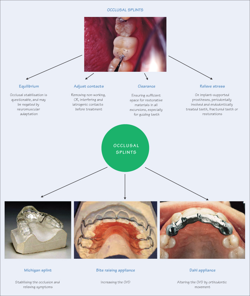 17 Occlusion adjustment and splints Pocket Dentistry