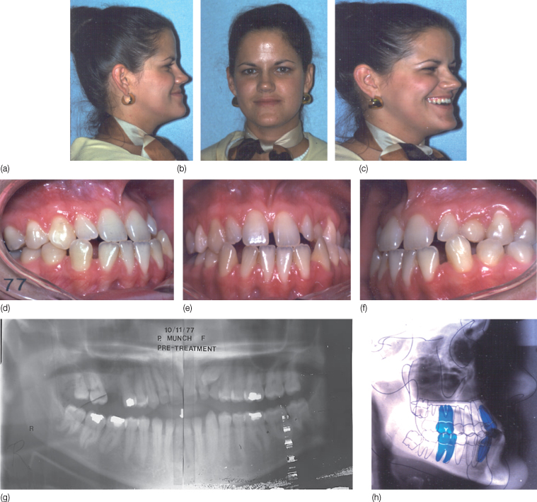 Orthodontic Treatment In Patients Requiring Orthognathic Surgical Procedures Pocket Dentistry