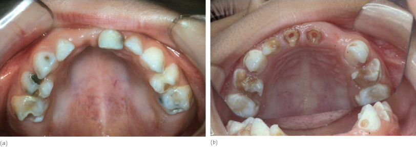 What Is Early Childhood Caries