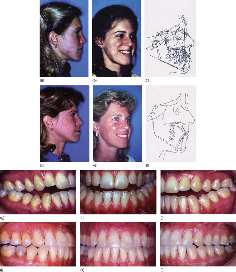 Clinical photographs of orthodontic treatment from pretreatment to