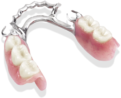 19: Partial denture base materials | Pocket Dentistry