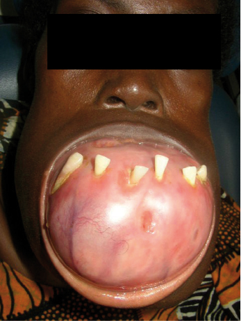 21: Odontogenic and Non-odontogenic Tumors of the Jaws 