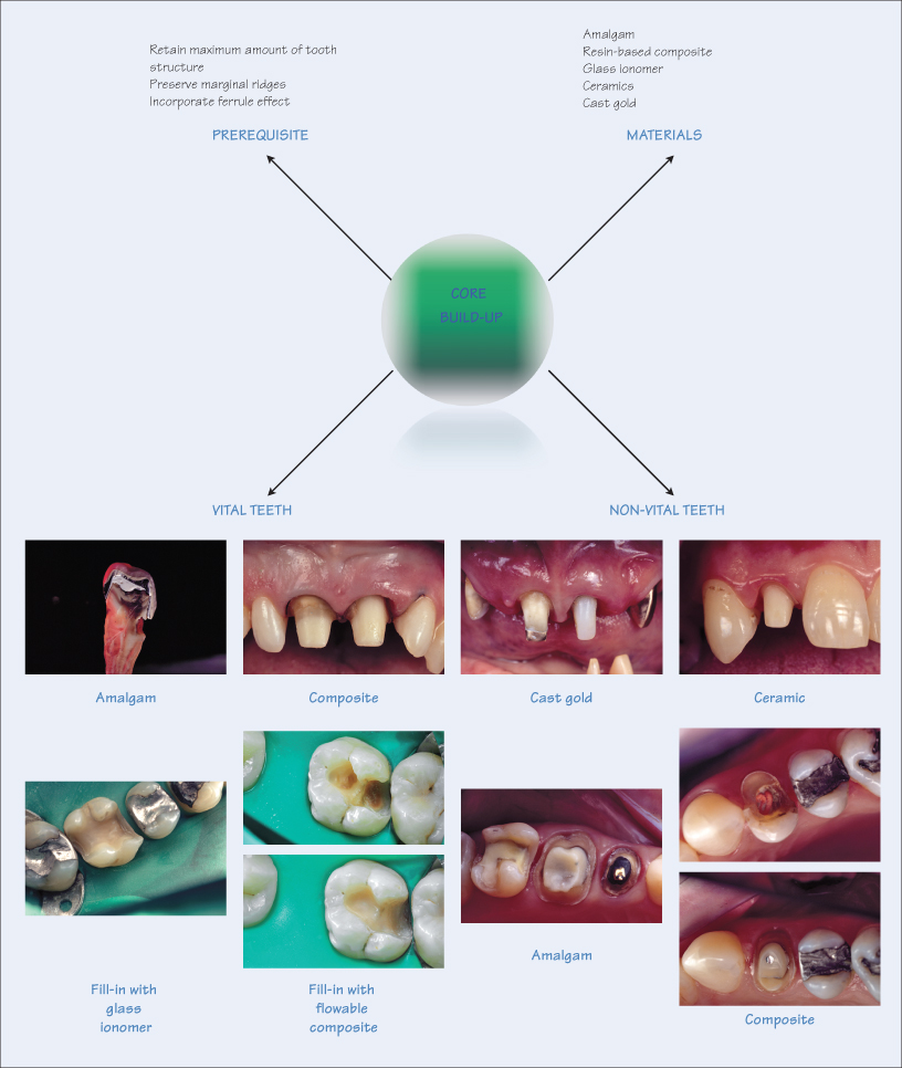 22 Coronal support: core build-up | Pocket Dentistry