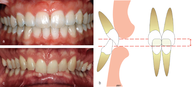 How to Fix an Overbite? Overbite Correction Treatments