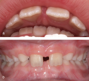 23 Deep overbite malocclusion