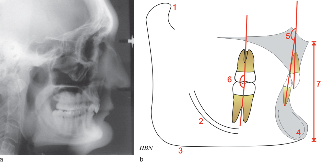 23 Deep overbite malocclusion