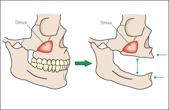 edentulous alveolar ridge classification