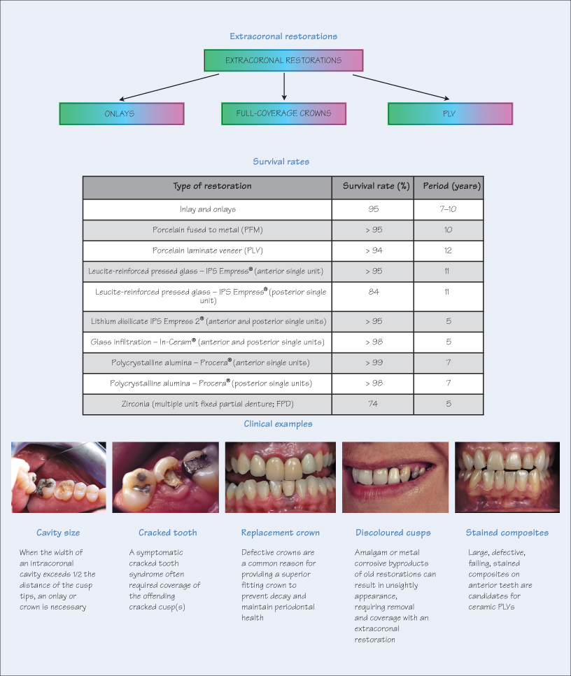 29 Choice of extracoronal restorations | Pocket Dentistry