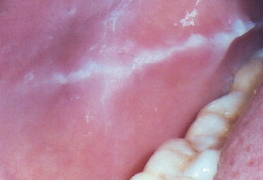 oral tissue soft keratosis frictional alba linea lesions common mucosa buccal fig occlusal plane mild due figure