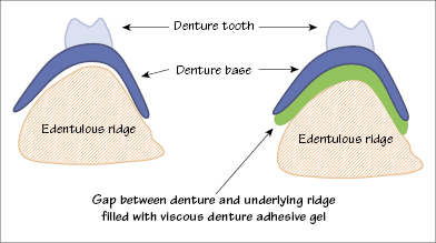 intaglio surface dentistry