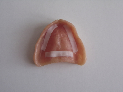 intaglio dental